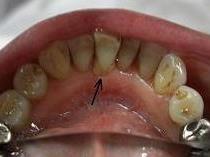 下の前歯　治療前