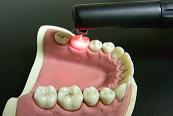 虫歯を検出するための精密機械